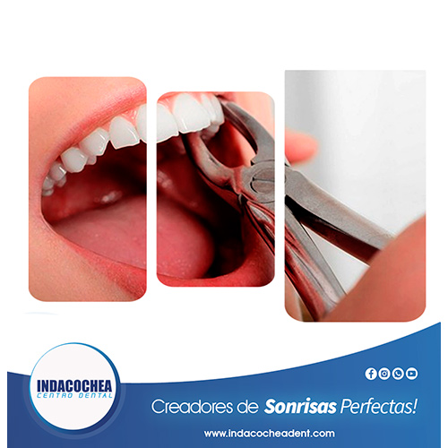 exodoncia dental Guayaquil