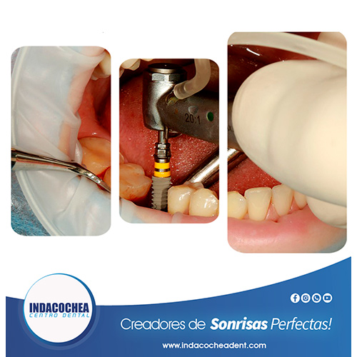 implante dental en Guayaquil