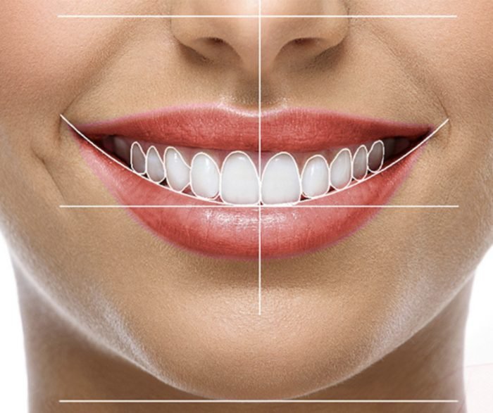Diseño de sonrisa