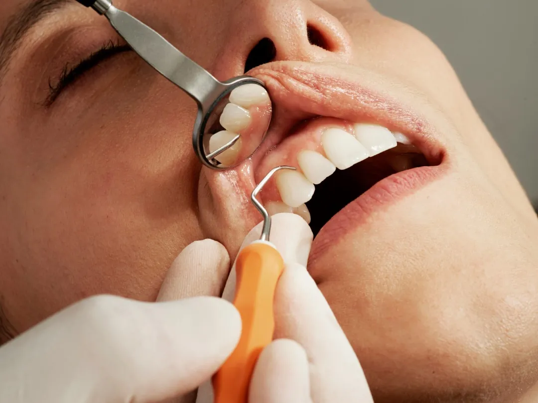 Limpieza dental