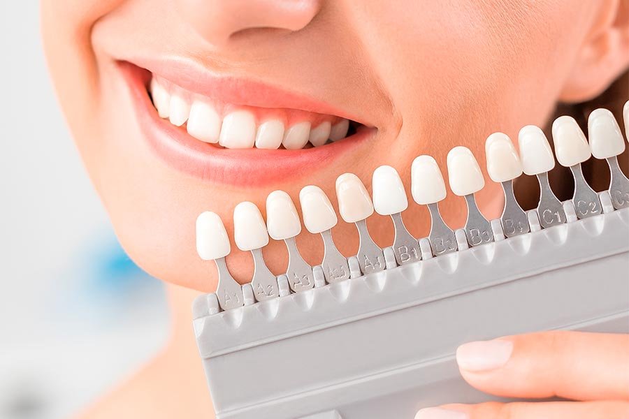 Carillas Dentales en Guayaquil