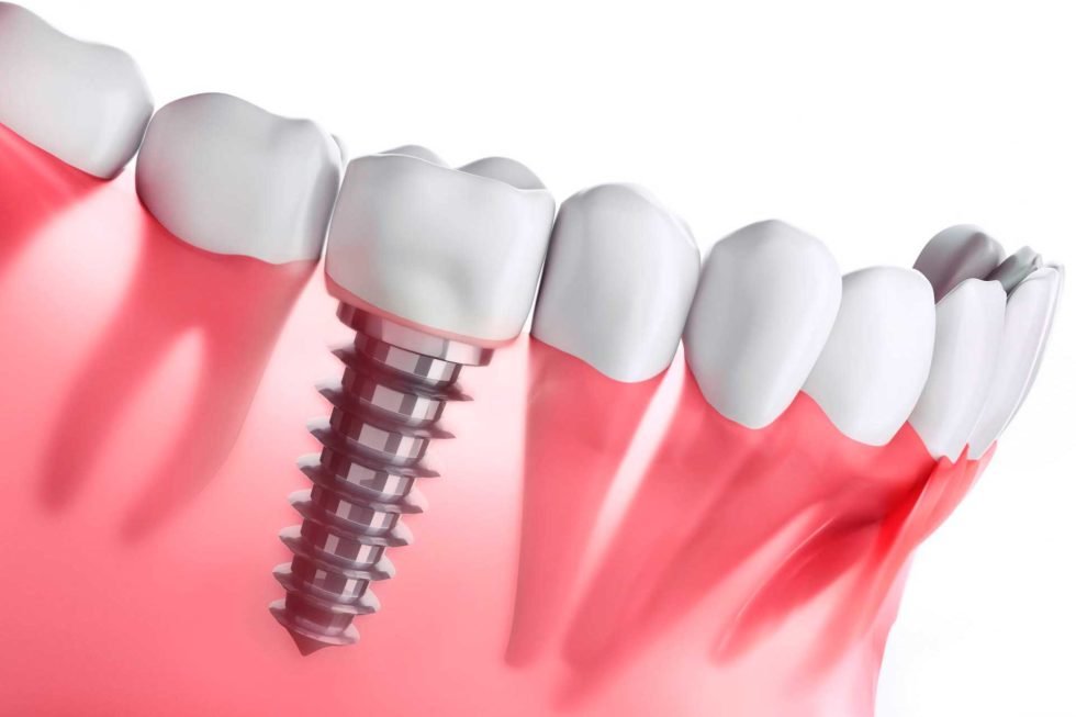 Implantes Dentales en Guayaquil