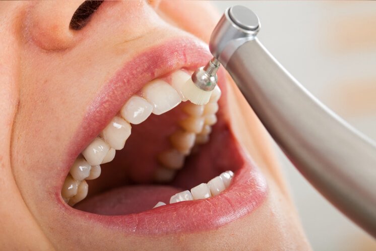 Profilaxis Dental en Guayaquil