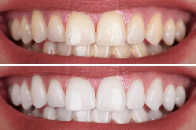 Blanqueamiento Dental