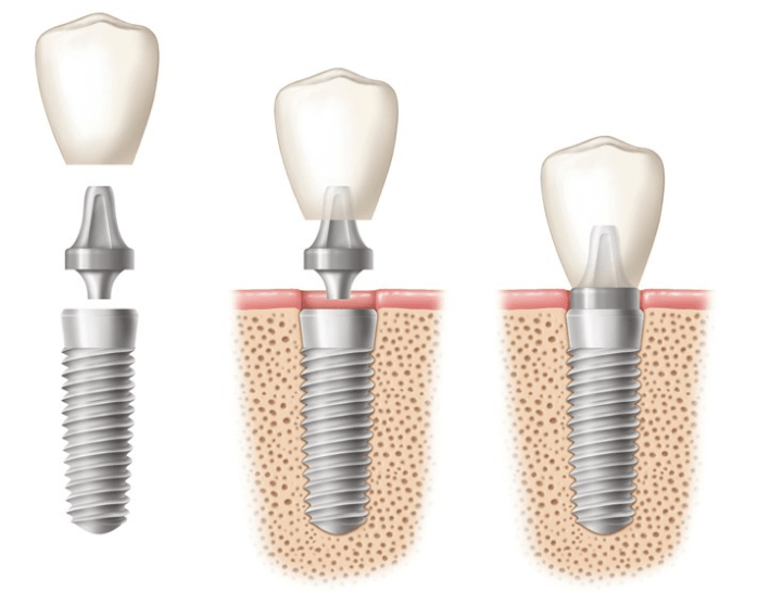 Implantes Dentales