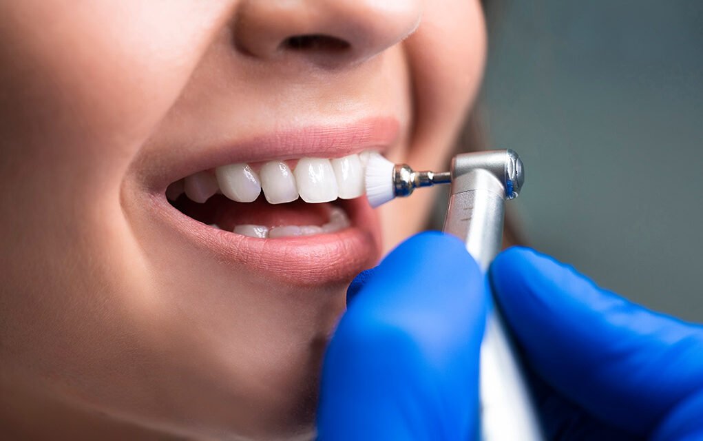 Profilaxis Dental
